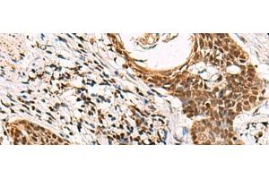 Immunohistochemistry of paraffin-embedded Human esophagus cancer tissue using GABPB1 Polyclonal Antibody at dilution of 1:70(x200) (GABPB1 antibody)