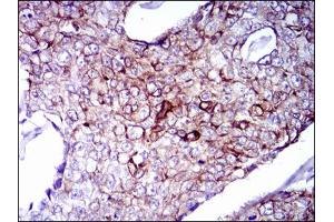 Immunohistochemical analysis of paraffin-embedded breast cancer tissues using CK5 antibody with DAB staining. (Cytokeratin 5 antibody)