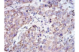 Immunohistochemical analysis of paraffin-embedded lung cancer tissues using PHB mouse mAb with DAB staining. (Prohibitin antibody)