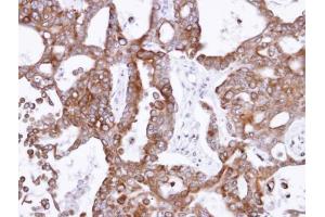 IHC-P Image Immunohistochemical analysis of paraffin-embedded NCIN87 xenograft , using PANK1, antibody at 1:500 dilution. (PANK1 antibody)