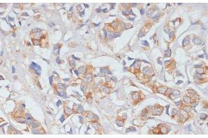 Immunohistochemistry of paraffin-embedded Human breast cancer using DLL1 Polyclonal Antibody at dilution of 1:100 (40x lens). (DLL1 antibody)