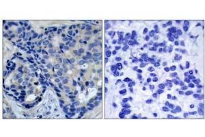 Immunohistochemical analysis of paraffin-embedded human breast carcinoma tissue, using Pyk2 (phospho-Tyr402) antibody (E011216). (PTK2B antibody  (pTyr402))