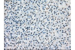 Immunohistochemical staining of paraffin-embedded Adenocarcinoma of colon tissue using anti-PORmouse monoclonal antibody. (POR antibody)
