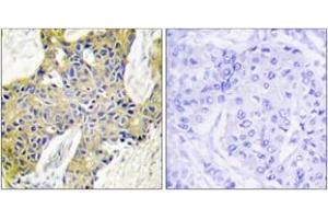 Immunohistochemistry analysis of paraffin-embedded human breast carcinoma tissue, using IARS2 Antibody. (IARS2 antibody  (AA 71-120))