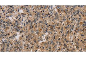 Immunohistochemistry of paraffin-embedded Human liver cancer tissue using ELAVL2 Polyclonal Antibody at dilution 1:40 (ELAVL2 antibody)
