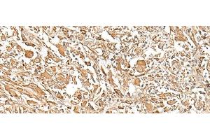 Immunohistochemistry of paraffin-embedded Human liver cancer tissue using PLBD1 Polyclonal Antibody at dilution of 1:25(x200) (PLBD1 antibody)
