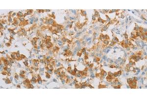 Immunohistochemistry of paraffin-embedded Human thyroid cancer tissue using REN Polyclonal Antibody at dilution 1:40 (Renin antibody)