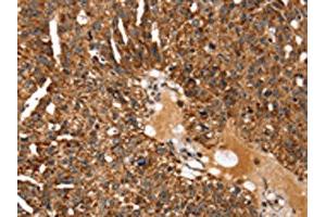The image on the left is immunohistochemistry of paraffin-embedded Human breast cancer tissue using ABIN7129957(KCNH6 Antibody) at dilution 1/30, on the right is treated with fusion protein. (KCNH6 antibody)