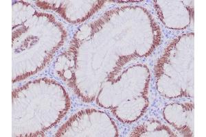 IHC analysis of formalin-fixed, paraffin-embedded human colon adenocarcinoma. (Recombinant CDX2 antibody)