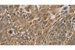 Immunohistochemistry of paraffin-embedded Human lung cancer using MYL3 Polyclonal Antibody at dilution of 1:45 (MYL3/CMLC1 antibody)