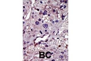 Formalin-fixed and paraffin-embedded human cancer tissue reacted with the primary antibody, which was peroxidase-conjugated to the secondary antibody, followed by AEC staining. (UCK antibody  (N-Term))