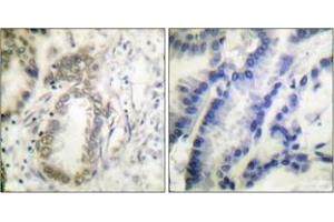 Immunohistochemistry analysis of paraffin-embedded human lung carcinoma, using C/EBP-alpha (Phospho-Ser21) Antibody. (CEBPA antibody  (pSer21))