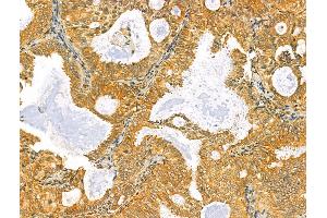 ABIN6264681 and ABIN6273070 at 1/100 staining Human lung cancer by IHC-P.