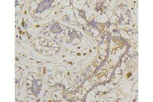 Immunohistochemistry of paraffin-embedded human mammary cancer using SLC2A1 antibody (ABIN5997113) at dilution of 1/100 (40x lens). (GLUT1 antibody)