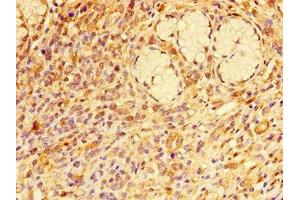 Immunohistochemistry of paraffin-embedded human gastric cancer using ABIN7167377 at dilution of 1:100 (RAB7A antibody  (AA 110-177))