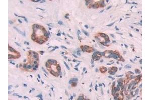 Detection of KRT6C in Human Pancreatic cancer Tissue using Polyclonal Antibody to Keratin 6C (KRT6C) (Keratin 6C antibody  (AA 163-482))