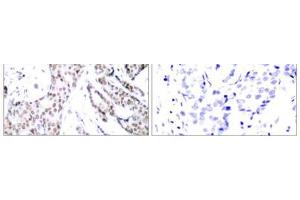 Immunohistochemical analysis of paraffin- embedded human breast carcinoma tissue using STAT3 (phospho-Ser727) antibody (E011046). (STAT3 antibody  (pSer727))