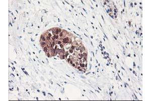 Immunohistochemical staining of paraffin-embedded Adenocarcinoma of Human breast tissue using anti-NIF3L1 mouse monoclonal antibody. (NIF3L1 antibody)