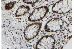 ABIN6267350 at 1/200 staining human colon carcinoma tissue sections by IHC-P. (Bcl-2 antibody  (pSer87))