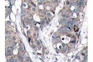 Immunohistochemistry analyzes of HSP27 antibody in paraffin-embedded human breast carcinoma tissue. (HSP27 antibody)