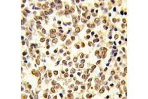 IHC analysis of FFPE human kideny carcinoma tissue stained with ERK5 antibody (MAPK7 antibody  (AA 776-805))