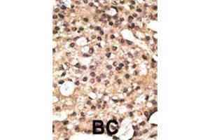 Formalin-fixed and paraffin-embedded human cancer tissue reacted with the primary antibody, which was peroxidase-conjugated to the secondary antibody, followed by DAB staining. (ATG4B antibody  (N-Term))