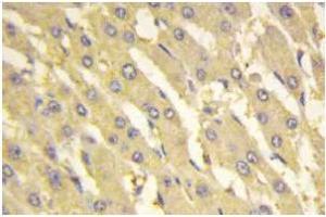 Immunohistochemistry: PFK-2 liv antibody staining of Paraffin-Embedded Human liver carcinoma tissue.