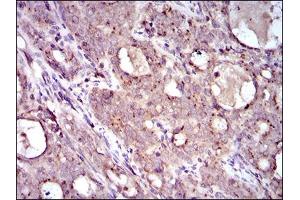 Immunohistochemical analysis of paraffin-embedded cervical cancer tissues using MRPL42 mouse mAb with DAB staining.
