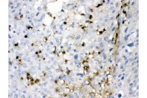 IHC testing of FFPE human liver cancer tissue with CA2 antibody at 1ug/ml. (CA2 antibody)
