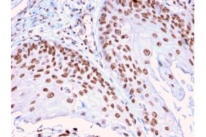 Formalin-fixed, paraffin-embedded human Cervical Carcinoma stained with CLEC9A Mouse Monoclonal Antibody (2H12/4). (DMC1 antibody)