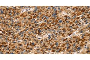 Immunohistochemistry of paraffin-embedded Human liver cancer using TLN1 Polyclonal Antibody at dilution of 1:30 (TLN1 antibody)