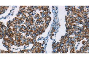 Immunohistochemistry of paraffin-embedded Human breast cancer using HINT2 Polyclonal Antibody at dilution of 1:50 (HINT2 antibody)