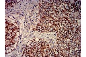 Immunohistochemical analysis of paraffin-embedded cervical cancer tissues using CD46 mouse mAb with DAB staining.