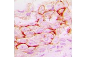 Immunohistochemical analysis of MMP14 staining in human breast cancer formalin fixed paraffin embedded tissue section. (MMP14 antibody  (C-Term))