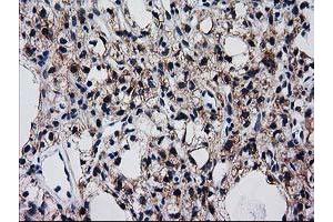 Immunohistochemical staining of paraffin-embedded Carcinoma of Human kidney tissue using anti-BIN3 mouse monoclonal antibody. (BIN3 antibody)