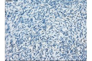 Immunohistochemical staining of paraffin-embedded Adenocarcinoma of breast tissue using anti-PRKAR1A mouse monoclonal antibody. (PRKAR1A antibody)