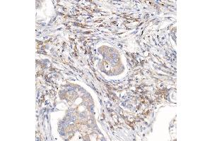 Immunohistochemistry of paraffin-embedded human lung cancer using RPL26L1 antibody (ABIN7270000) at dilution of 1:50 (40x lens). (RPL26L1 antibody)