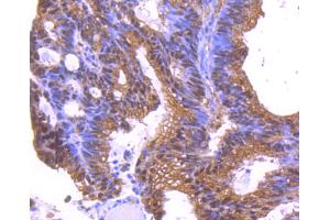 Paraformaldehyde-fixed, paraffin embedded human colon cancer, Antigen retrieval by boiling in sodium citrate buffer (pH6. (YWHAE antibody)