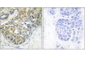 Immunohistochemistry analysis of paraffin-embedded human breast carcinoma, using ACK1 (Phospho-Tyr284) Antibody. (TNK2 antibody  (pTyr284))