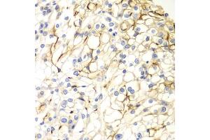 Immunohistochemistry of paraffin-embedded human kidney cancer using V antibody (ABIN6132779, ABIN6150054, ABIN6150055 and ABIN6223794) at dilution of 1:100 (40x lens). (VANGL2 antibody  (AA 1-110))