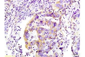 Formalin-fixed and paraffin-embedded : human colon carcinoma labeled with Rabbit Anti-WNK3 protein Polyclonal Antibody , Unconjugated 1:200 followed by conjugation to the secondary antibody (WNK3 antibody  (AA 451-550))