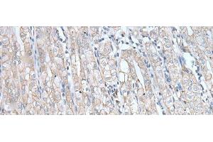 Immunohistochemistry of paraffin-embedded Human gastric cancer tissue using SPTA1 Polyclonal Antibody at dilution of 1:80(x200) (SPTA1 antibody)