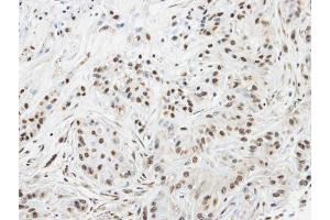 IHC-P Image Immunohistochemical analysis of paraffin-embedded A549 xenograft, using SPHK1, antibody at 1:100 dilution. (SPHK1 antibody  (C-Term))