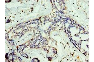 Immunohistochemistry of paraffin-embedded human breast cancer using ABIN7153848 at dilution of 1:100 (GAN antibody  (AA 1-240))