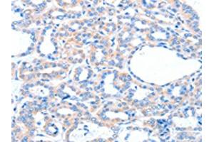 The image on the left is immunohistochemistry of paraffin-embedded Human thyroid cancer tissue using ABIN7128170(ACOX1 Antibody) at dilution 1/20, on the right is treated with fusion protein. (ACOX1 antibody)