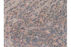 IHC-P analysis of Human Prostate Gland Cancer Tissue, with DAB staining. (MTOR antibody  (AA 2226-2488))