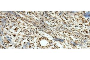 Immunohistochemistry of paraffin-embedded Human breast cancer tissue using MLF1 Polyclonal Antibody at dilution of 1:105(x200) (MLF1 antibody)
