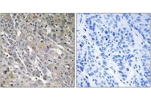 Immunohistochemistry analysis of paraffin-embedded human lung carcinoma tissue, using ARHGEF9 Antibody. (Arhgef9 antibody  (AA 399-448))