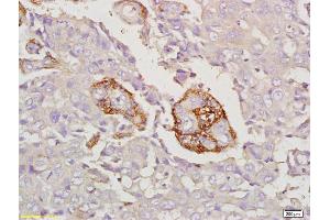 Formalin-fixed and paraffin embedded human laryngeal carcinoma labeled with Anti-MAL/MPV17 Polyclonal Antibody, Unconjugated (ABIN1386760) at 1:200 followed by conjugation to the secondary antibody and DAB staining (MAL antibody  (AA 81-153))