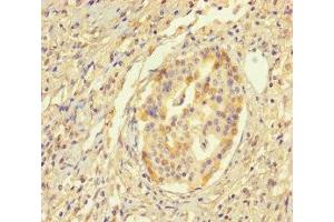 Immunohistochemistry of paraffin-embedded human pancreatic cancer using ABIN7155943 at dilution of 1:100 (Chromosome X Open Reading Frame 27 (CXORF27) (AA 1-117) antibody)